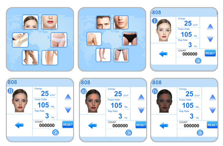 Beauty Clinic Wanted Best Quality 808nm Diode Laser Hair Removal Machine Beauty Clinic Wanted Best Quality 808nm Diode Laser Hair Removal Machine