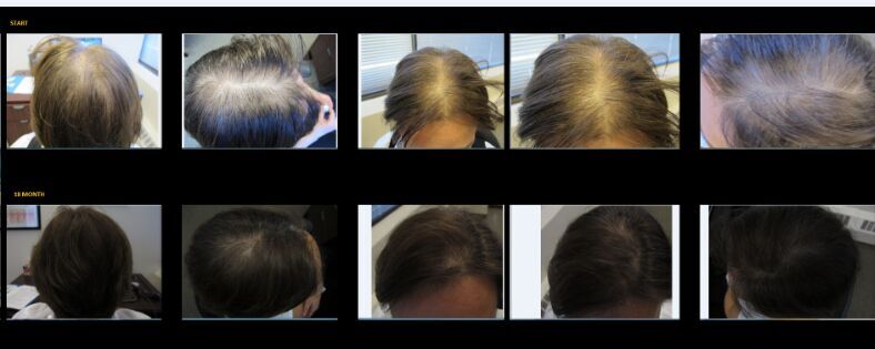 Best Price Laser Hair Regrowth Machine Best Price Laser Hair Regrowth Machine