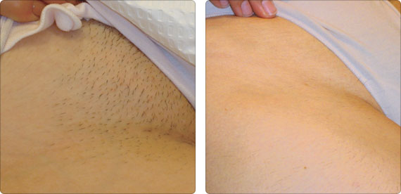 IPL E-light SHR 3 In 1 Hair Removal And Skin Rejuvenation System IPL E-light SHR 3 In 1 Hair Removal And Skin Rejuvenation System