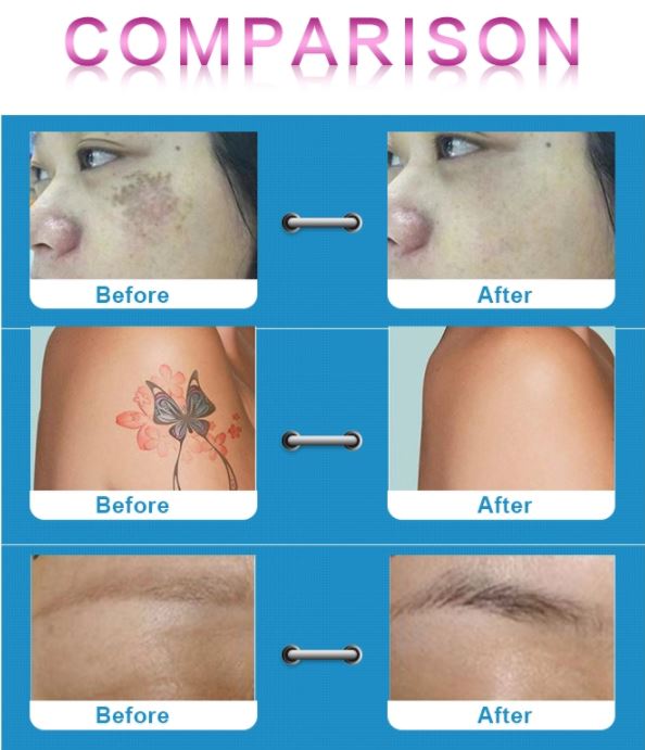 The Most Popular Picosecond Laser CE Approved Machine Pico Laser For Tattoo Removal The Most Popular Picosecond Laser CE Approved Machine Pico Laser For Tattoo Removal