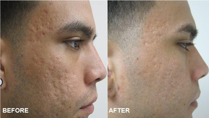 Hot!!Acne Scars Laser Skin Treatment Fraction C02 Laser Hot!!Acne Scars Laser Skin Treatment Fraction C02 Laser