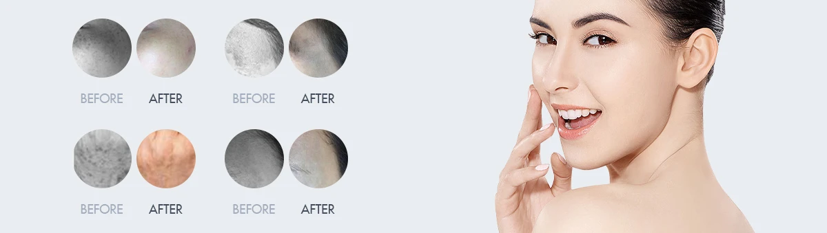 Picosecond Laser For Tattoo Removal Picosecond Laser For Tattoo Removal